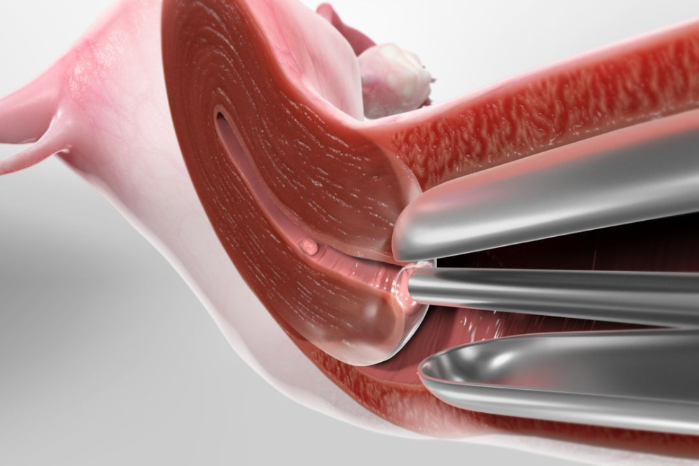  Hysteroscopy